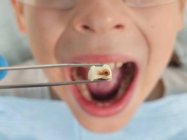 Best Emergency Root Canal Treatment in Stewartville, AL