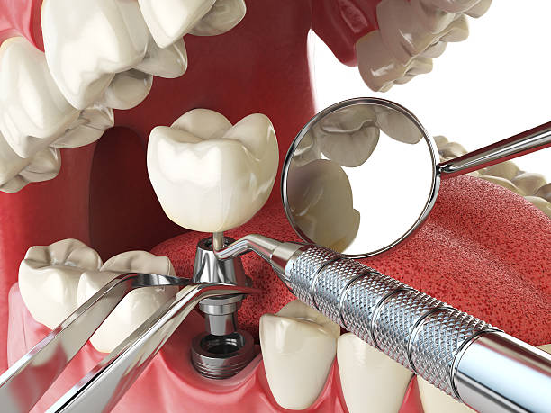 Best Emergency Tooth Extraction in Stewartville, AL